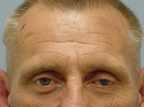 Face Fat Grafting