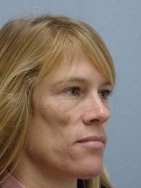 Face Fat Grafting