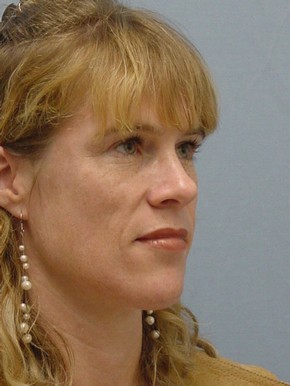 Face Fat Grafting