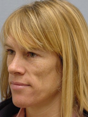 Face Fat Grafting
