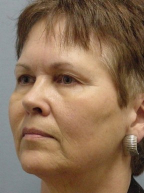 Facelift