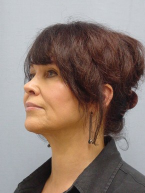 Facelift