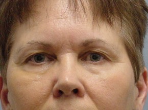 Facelift