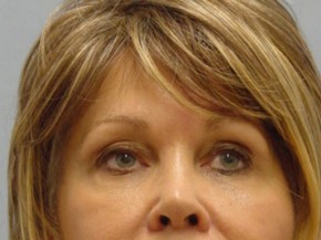 Facelift