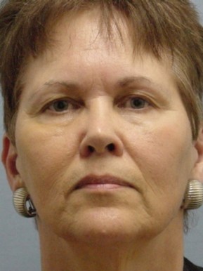 Facelift