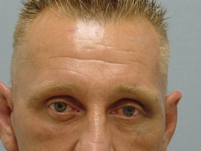 Facelift