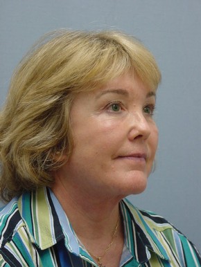 Facelift