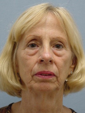 Facelift