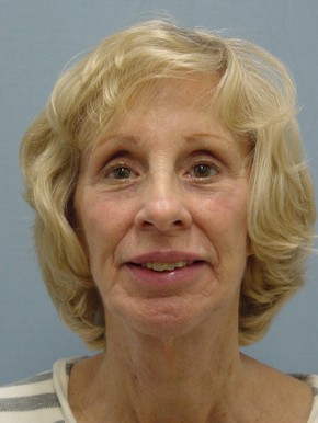 Facelift