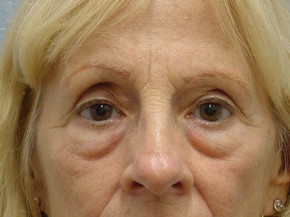 Facelift