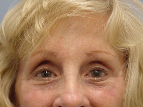 Facelift