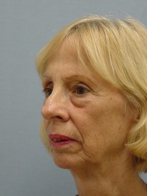 Facelift