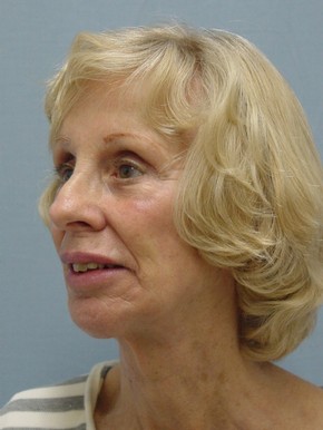 Facelift