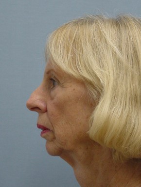 Facelift