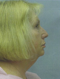 Facelift