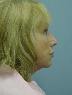 Facelift