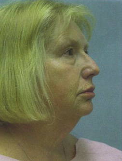 Facelift