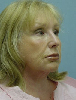 Facelift