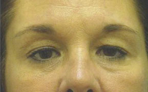 Facelift