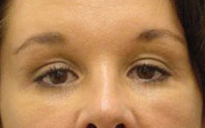 Facelift