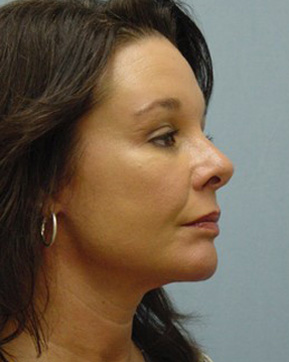 Facelift
