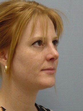 Rhinoplasty