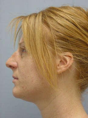 Rhinoplasty