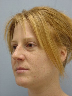 Rhinoplasty