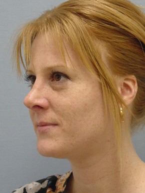 Rhinoplasty