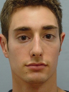 Rhinoplasty