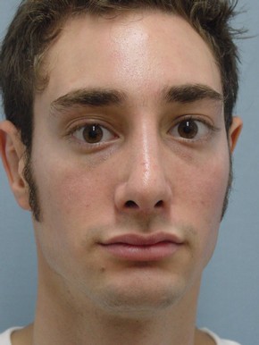 Rhinoplasty
