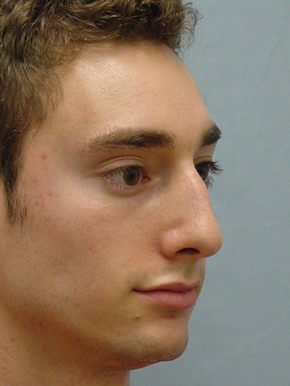 Rhinoplasty