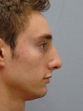 Rhinoplasty