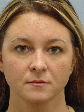 Rhinoplasty