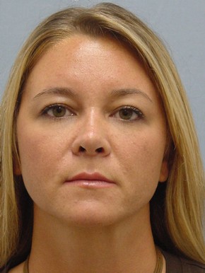 Rhinoplasty