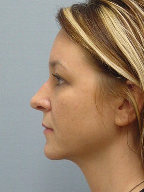 Rhinoplasty