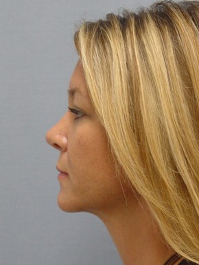 Rhinoplasty