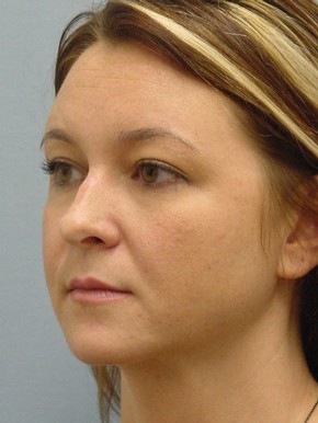 Rhinoplasty