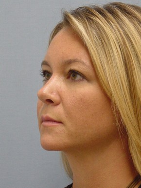 Rhinoplasty