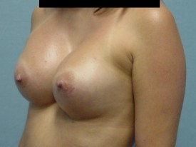 Breast Augmentation Gel