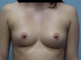 Breast Augmentation Gel