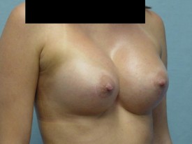 Breast Augmentation Gel