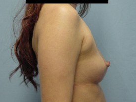 Breast Augmentation Gel