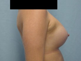 Breast Augmentation Gel