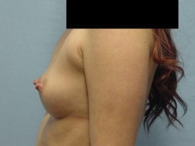 Breast Augmentation Gel