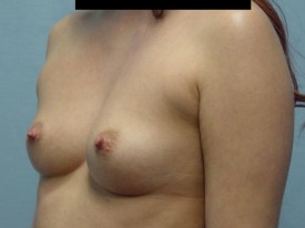 Breast Augmentation Gel