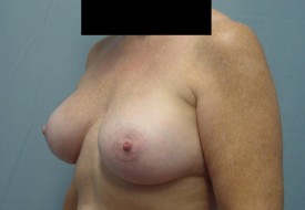 Breast Augmentation Gel