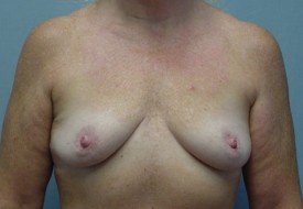 Breast Augmentation Gel