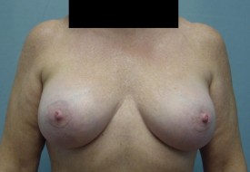 Breast Augmentation Gel