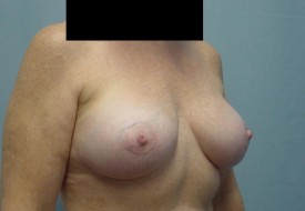 Breast Augmentation Gel
